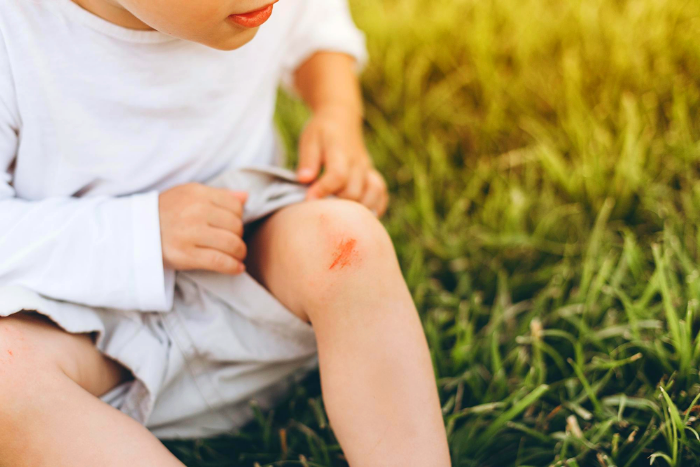 أسباب كدمات الساق عند الأطفال